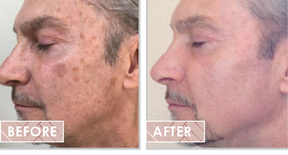 Halo laser before after