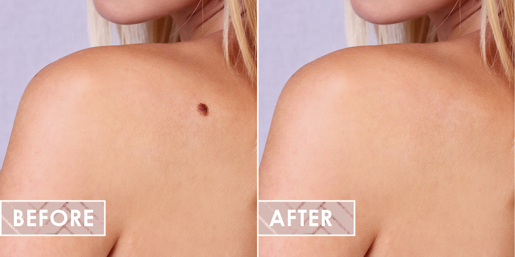 Vinesse Aesthetics and Cosmetic Clinic Before After Cosmetic Mole Removal