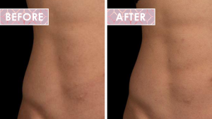Vinesse-Aesthetics-and-Cosmetic-Clinic-Results-Trusculpt-Flex-before-after