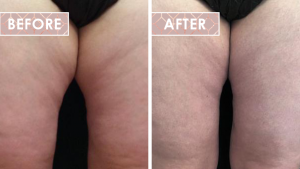 truSculpt iD at Vinesse Aesthetics and Cosmetic Clinic before after