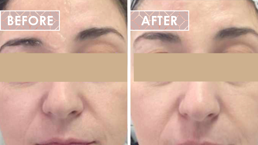 Vinesse-Aesthetics-and-Cosmetic-Clinic-HIFU-Before-After-05