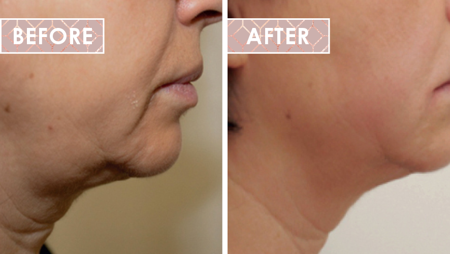 Vinesse-Aesthetics-and-Cosmetic-Clinic-HIFU-Results-0