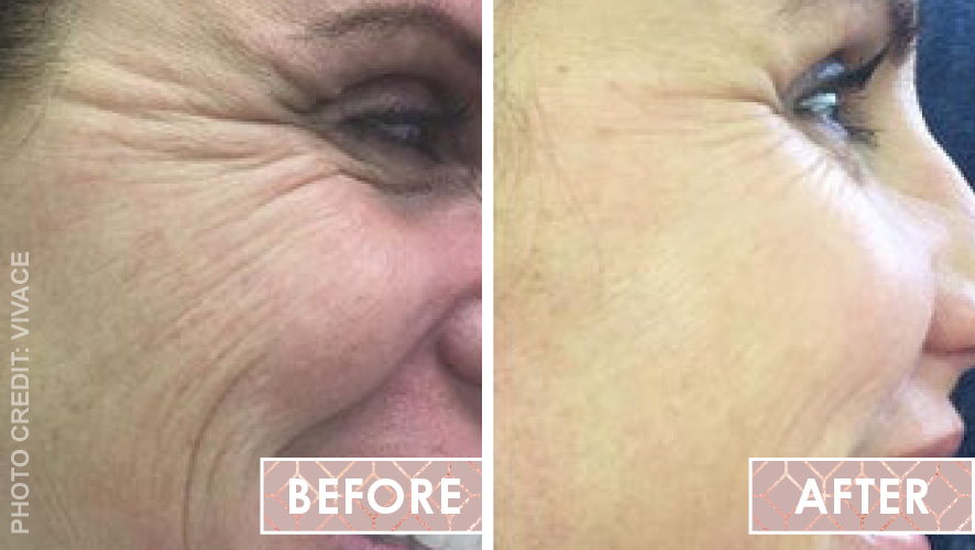 Vinesse-Aesthetics-and-Cosmetic-Clinic-Results-Skin-Microneedling-Vivace