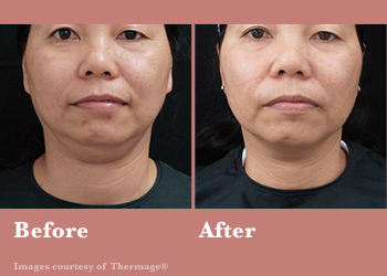 Thermage FLX- Before After Results Vinesse Aesthetics