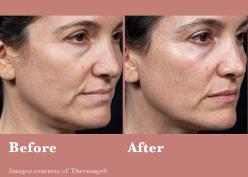 Thermage FLX- Before After Results Vinesse Aesthetics2