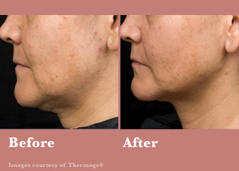 Thermage FLX- Before After Results Vinesse Aesthetics4