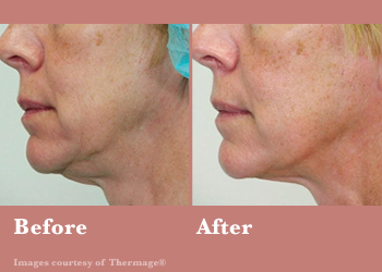 Thermage FLX- Before After Results Vinesse Aesthetics5