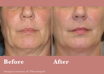 Thermage FLX- Before After Results Vinesse Aesthetics6