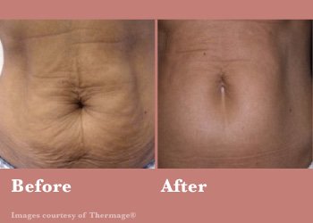 Thermage FLX-Digi-Before-After-Body-02