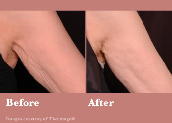 Before and After Thermage FLX Vinesse Aesthetics