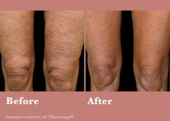 Before and After Thermage FLX Vinesse Aesthetics