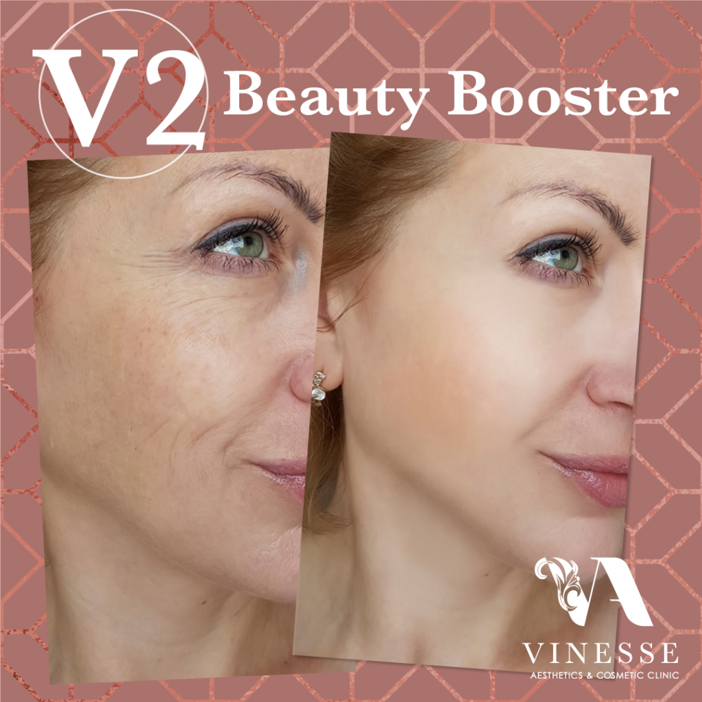 V2 beauty booster before after Vinesse Aesthetics