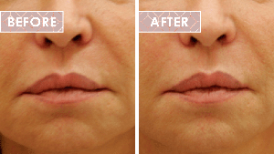 Vinesse-Aesthetics-and-Cosmetic-Clinic-HIFU-Before-After-0-min