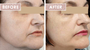 Vinesse-Aesthetics-and-Cosmetic-Clinic-HIFU-Before-After-03-min