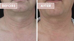 Vinesse-Aesthetics-and-Cosmetic-Clinic-HIFU-Before-After-04-min