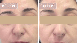 Vinesse-Aesthetics-and-Cosmetic-Clinic-HIFU-Before-After-05-min