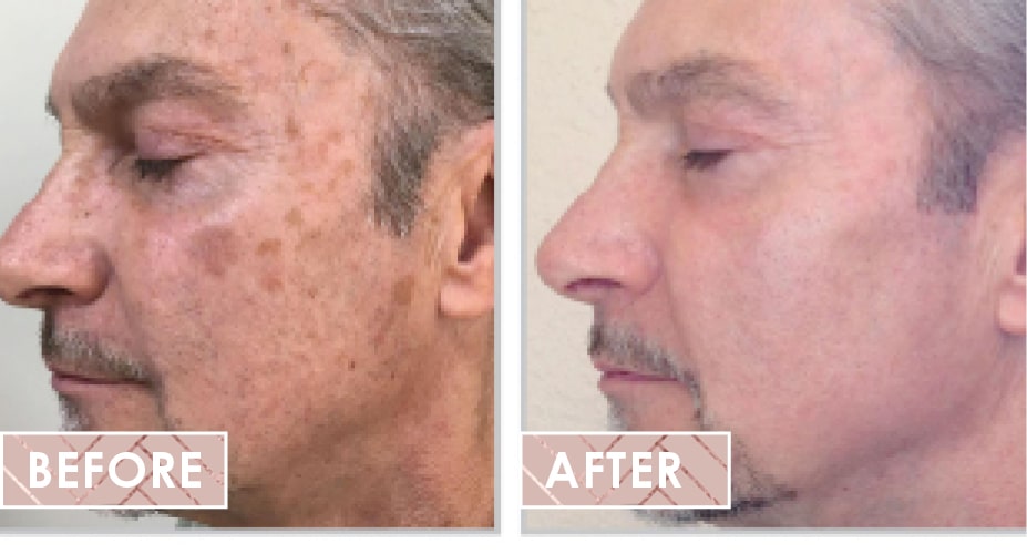 Vinesse-Aesthetics-and-Cosmetic-Clinic-Halo-before-after-min