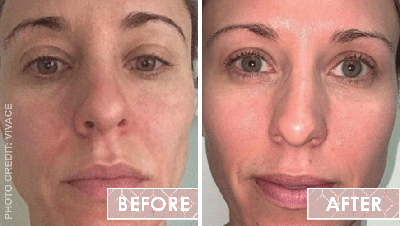Vinesse-Aesthetics-and-Cosmetic-Clinic-Results-Skin-Microneedling-Vivace2-min
