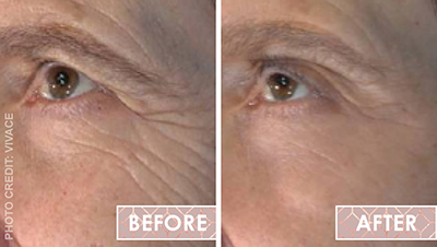 Vinesse-Aesthetics-and-Cosmetic-Clinic-Results-Skin-Microneedling-Vivace3-min