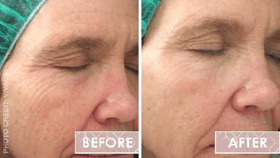 Vinesse-Aesthetics-and-Cosmetic-Clinic-Results-Skin-Microneedling-Vivace4-min