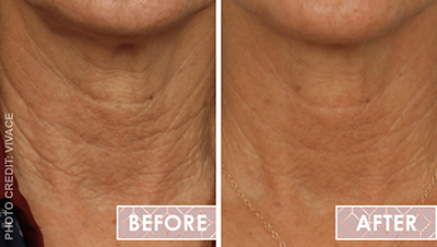 Vinesse-Aesthetics-and-Cosmetic-Clinic-Results-Skin-Microneedling-Vivace5-min