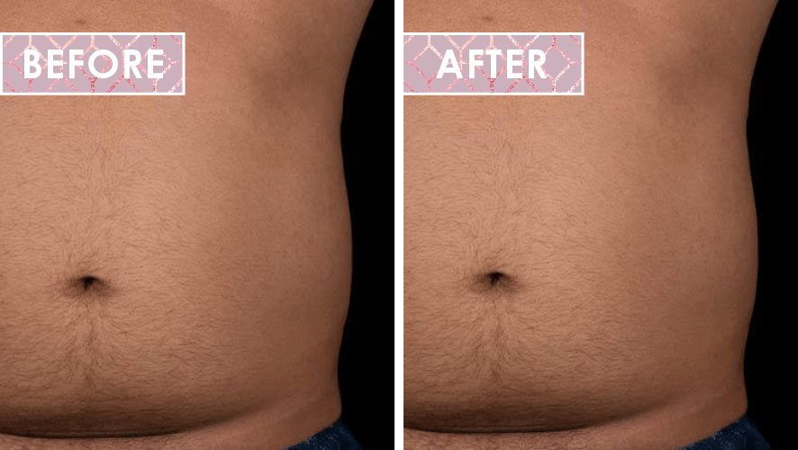 Vinesse-Aesthetics-and-Cosmetic-Clinic-Results-Trusculpt-Flex-before-after-0-min