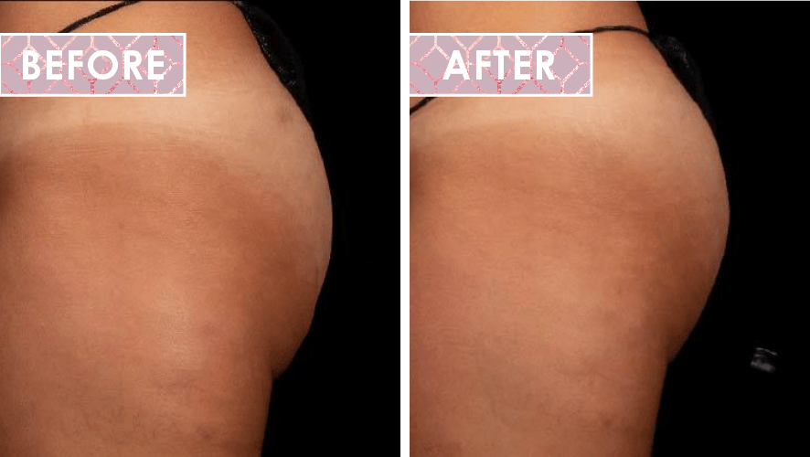 Vinesse-Aesthetics-and-Cosmetic-Clinic-Results-Trusculpt-Flex-before-after-03-min