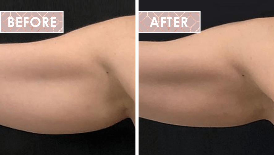 Vinesse-Aesthetics-and-Cosmetic-Clinic-Results-Trusculpt-ID