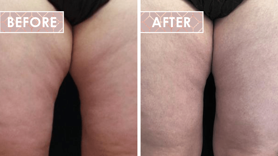 Vinesse-Aesthetics-and-Cosmetic-Clinic-Results-Trusculpt-ID-02