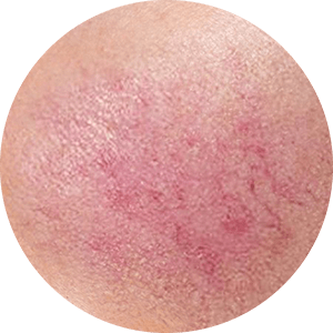 Vinesse-Aesthetics-and-Cosmetic-Clinic-Rosacea