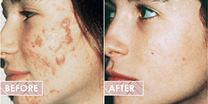 Vinesse-Aesthetics-and-Cosmetic-Clinic-results-microdermabrasion