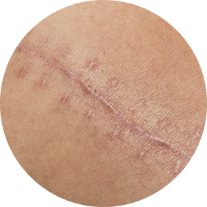 Vinesse-Aesthetics-and-Cosmetic-Clinic-scar-removal