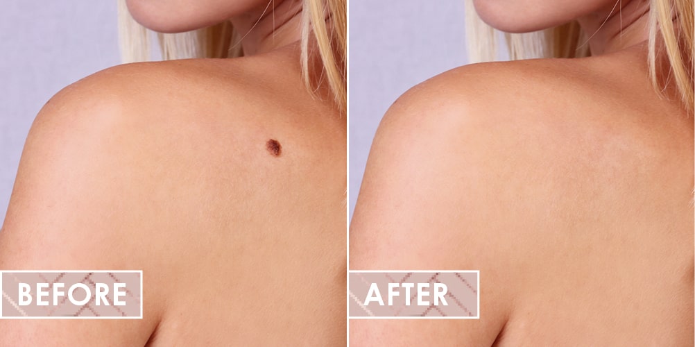 Vinesse-Aesthetics-and-cosmetic-clinic-cosmetic-mole-removal-before-after-min